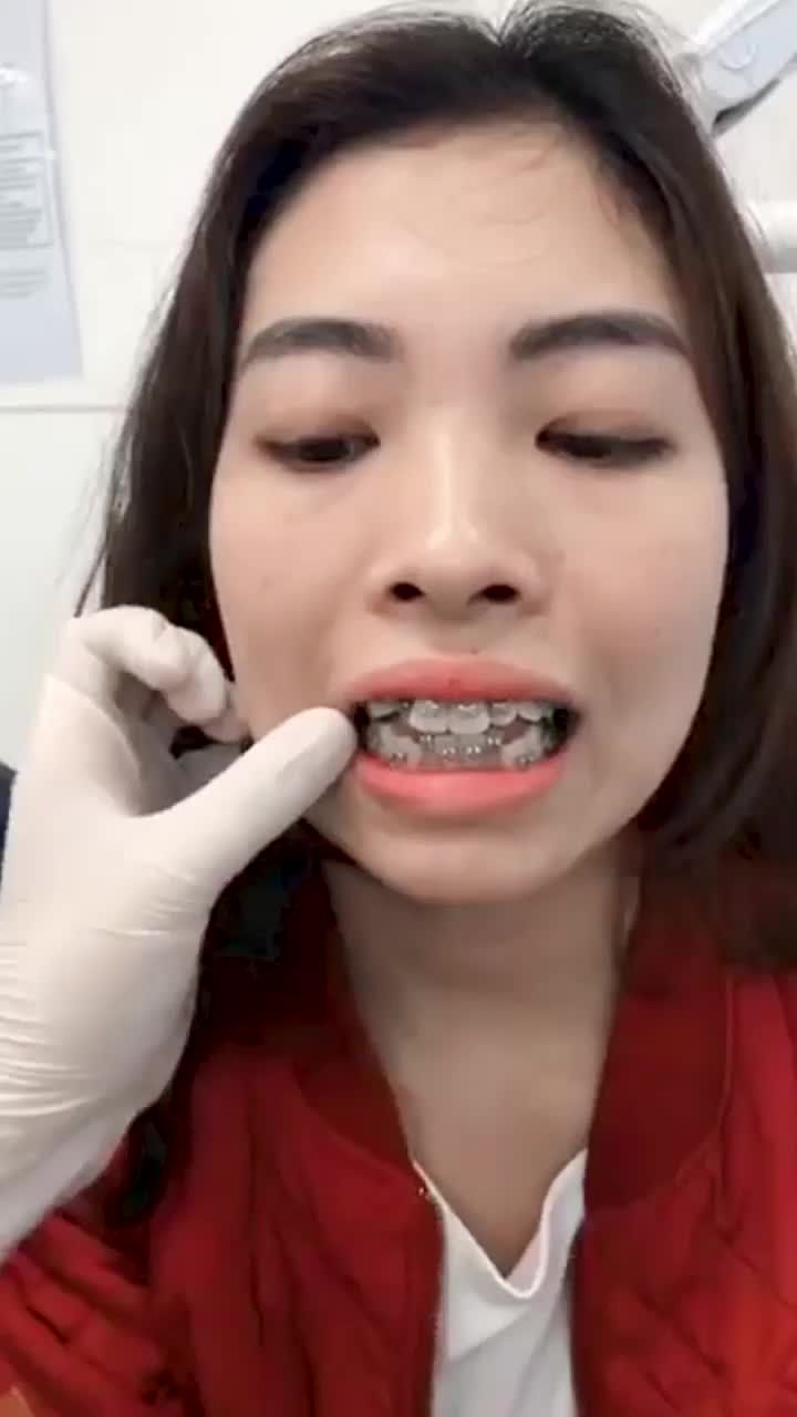 Niềng răng chữa hô - Khấp khểnh thế nào?